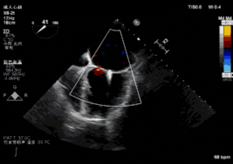 葛均波院士团队完成一例新一代超声引导下的ValveClamp术